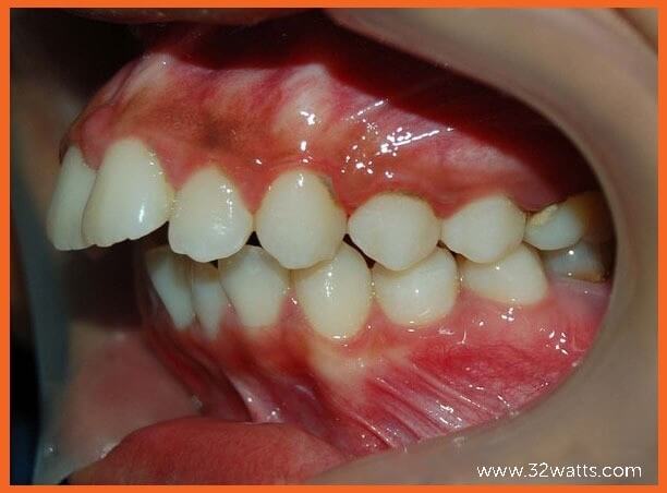 orthodontic braces teeth picture