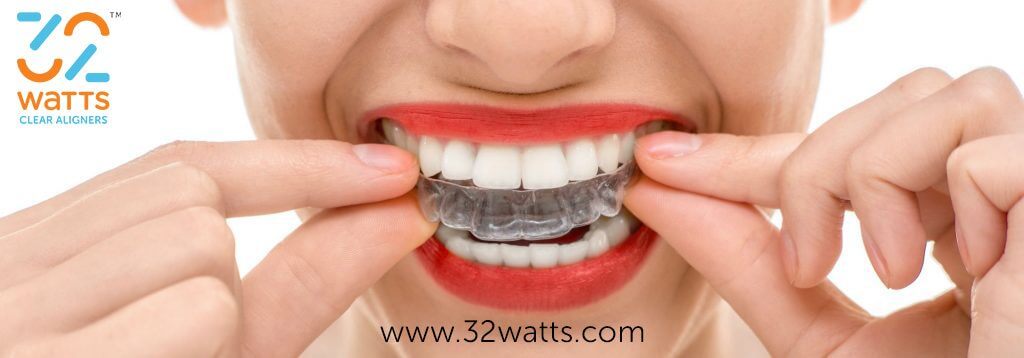difference between aligners and braces