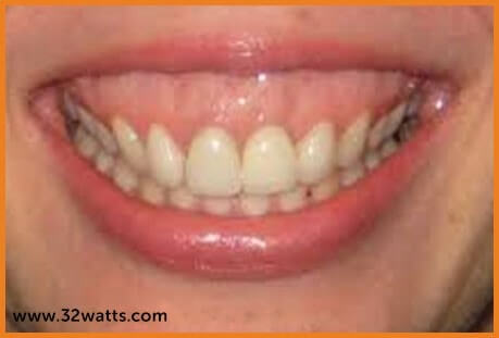 32 Watts - Lips and Orthodontics