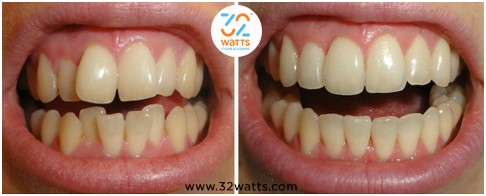 Clear aligners before and after Picture