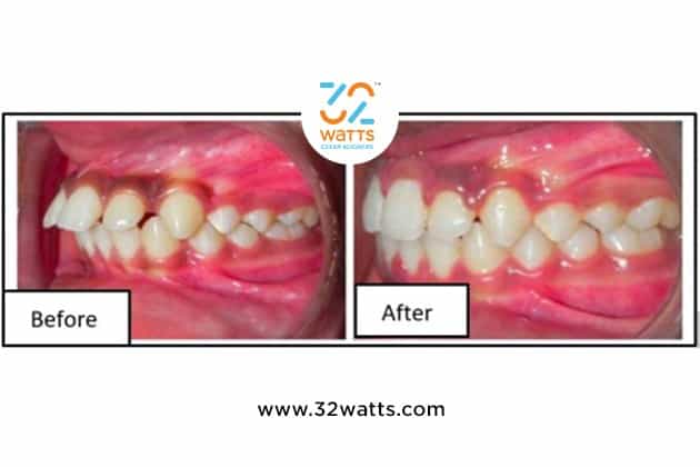 Clear Aligners Before And After In India