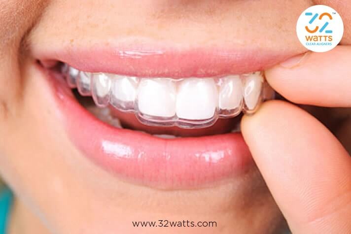 Best invisible braces in India