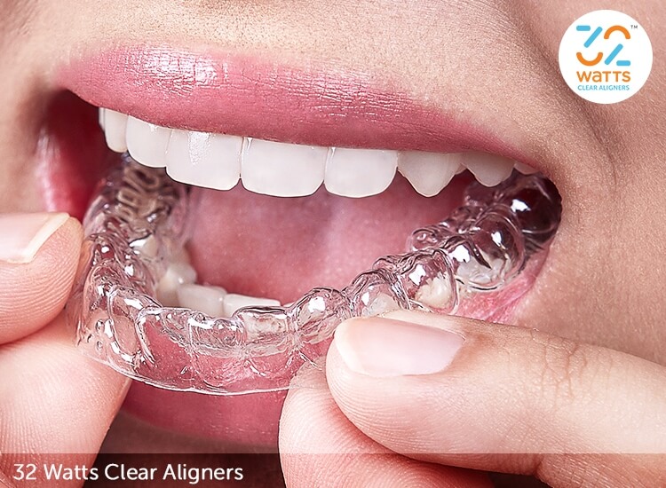 How to Wear Clear Aligners