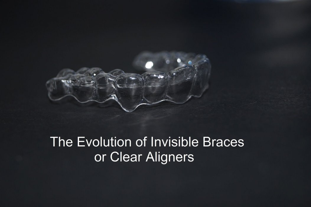 What are Clear Aligners 32Watts