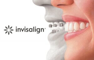 Is Invisalign a brand of clear aligners in India?