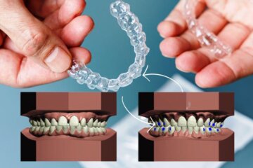 What are attachments in clear aligner treatment?