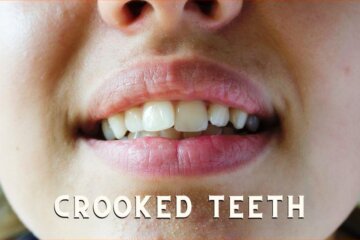 Can Crooked Teeth be corrected through transparent teeth braces?